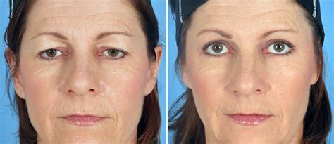 Why Eyelid Lift Surgery Consistently Tops the Charts (+ What it Can Do for You) - Swan Center ...