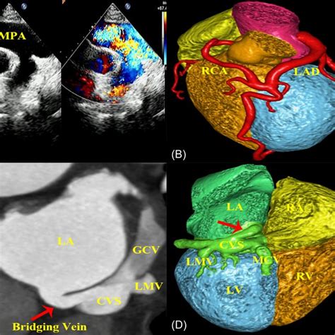 (A) Transthoracic echocardiography reveals a thickened pulmonary valve... | Download Scientific ...