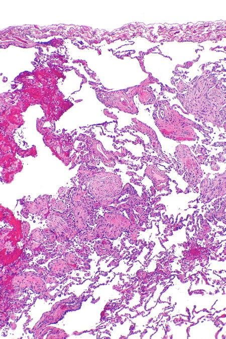 Organizing pneumonia - Libre Pathology