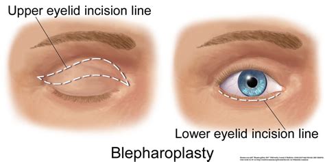 Eyelid Surgery Panama City | Blepharoplasty Panama City | The Eye ...