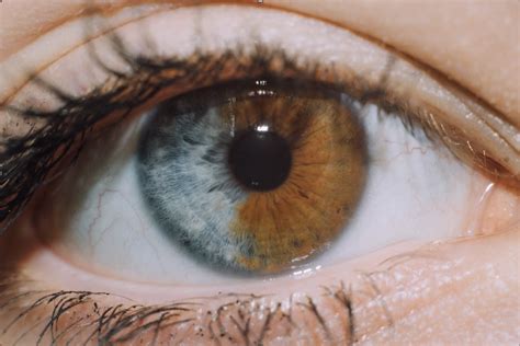 Heterochromia: A Beautiful Anomaly - Southeastern Ocularists Inc.