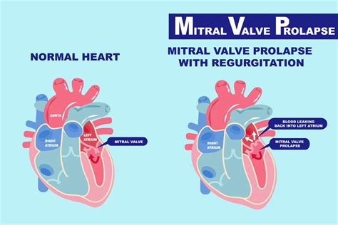 What You Need to Know About Mitral Valve Prolapse