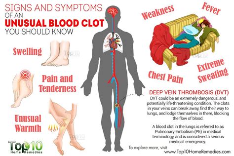 10 Signs & Symptoms of an Unusual Blood Clot You Should Know | Top 10 Home Remedies