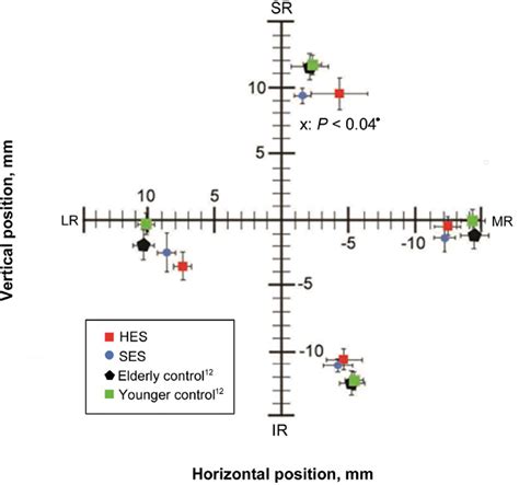 Heavy eye syndrome versus sagging eye syndrome in high myopia. | Semantic Scholar