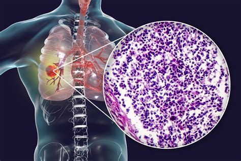 Novel Target Protein Discovered to Treat Small Cell Lung Cancer | Oncotarget