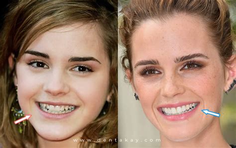 6 Shocking celebrity veneers with before & after pictures