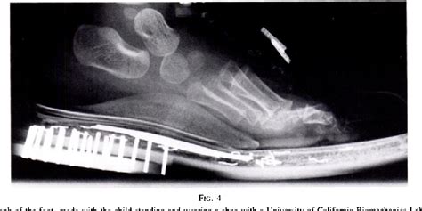 Talipes Calcaneovalgus | Semantic Scholar