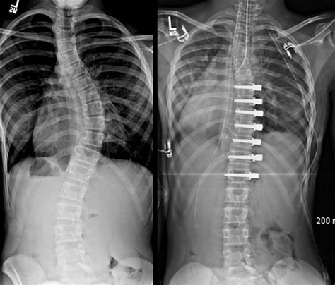 Scoliosis Surgery Gone Wrong