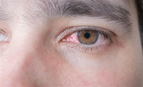 3 Critical Steps to Take If You Injure Your Eye - Valley Eyecare