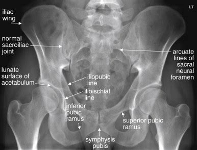 Pelvis Anatomy Xray