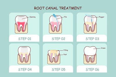 How Root Canal Therapy Can Help Injured Teeth - Fort Lee Family Dental Fort Lee New Jersey