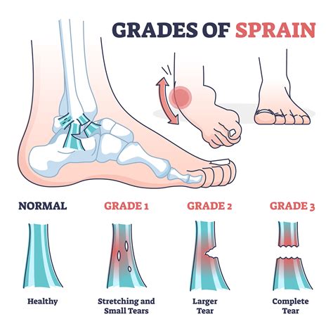 Ankle Sprain Grades 1