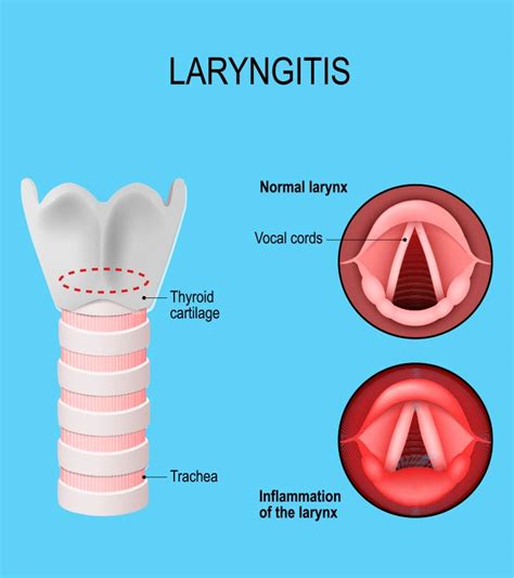 Laryngitis In Kids: Types, Causes, Symptoms, And Treatment – AceParents.com