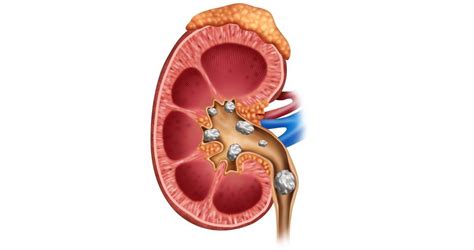 Do Calcium Supplements Contribute to the Formation of Kidney Stones ...