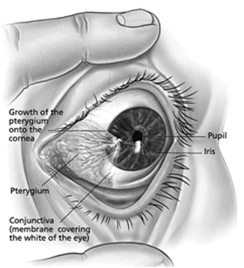 Pterygium surgery – Opthalmologist, Gold Coast