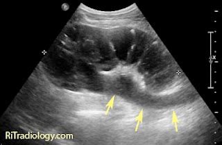 RiT radiology: Pyonephrosis