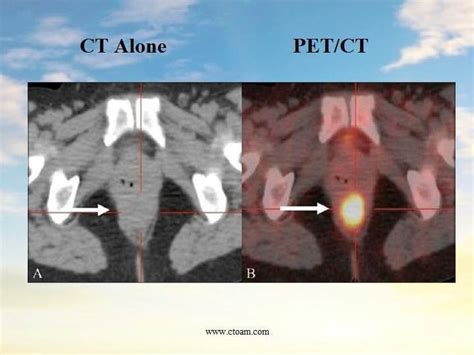 CT Vs Pet Scan