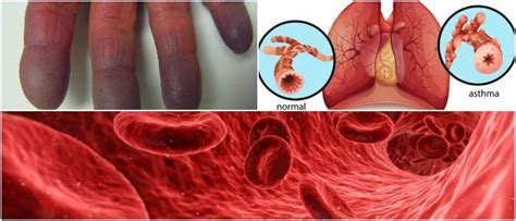 Hypoxemia Vs Hypoxia: Causes, Symptoms, and Treatment - Hoool Health & Wellness