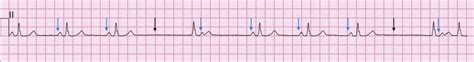 Sinoatrial Exit Block • LITFL • ECG Library Diagnosis