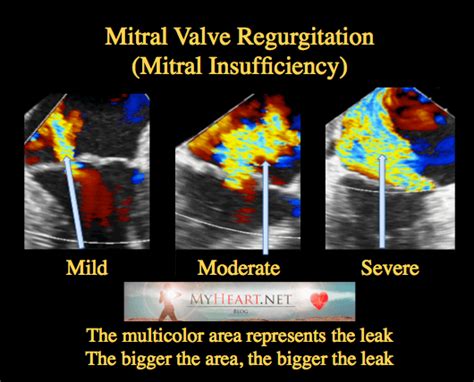 Mitral Valve Regurgitation (Mitral Insufficiency) myheart.net