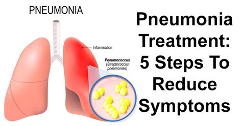 Pneumonia Treatment: 5 Steps To Reduce Symptoms - DavidWolfe.com