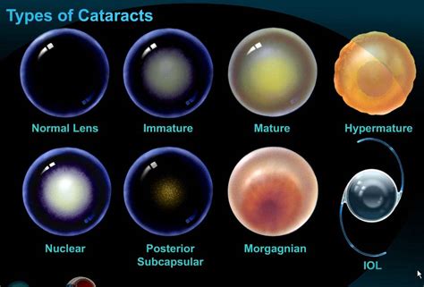 eyesitemd.com - Cataract