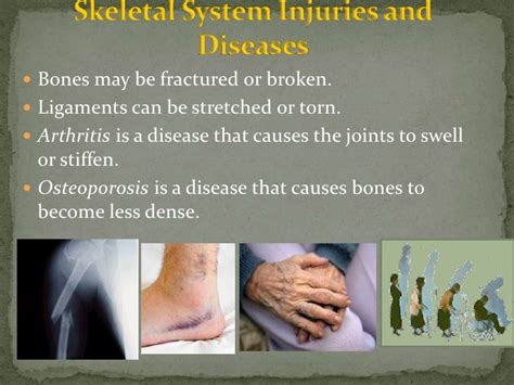 Diseases Of Skeletal System