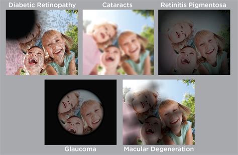 A Perspective on Eye Diseases - Pearl Interactive Network