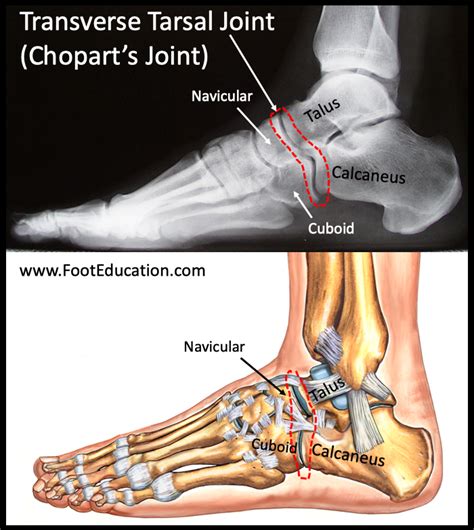 Transverse Tarsal Joint Injury-Sprain - FootEducation