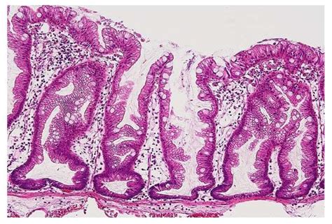 Sessile Polyp Histology