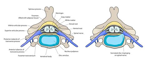 Spinal Disc Herniation | Bone and Spine