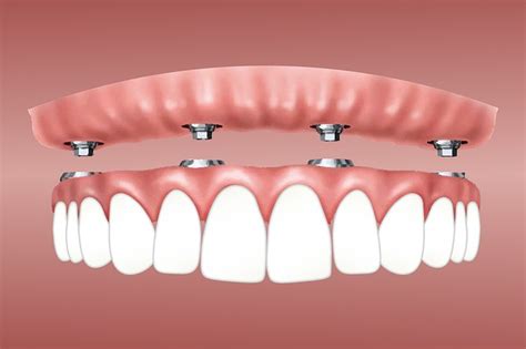 What are the Different Types of Dental Implants - FYI - Dental Group