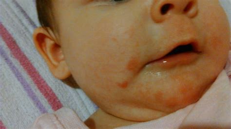 Is this a teething rash? - September 2014 - BabyCenter Australia