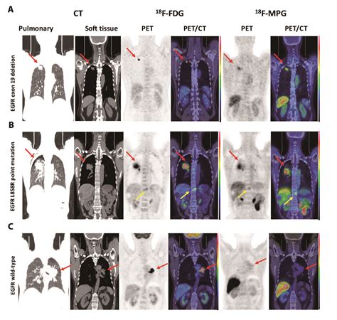 Pet Scan Images Lung Cancer