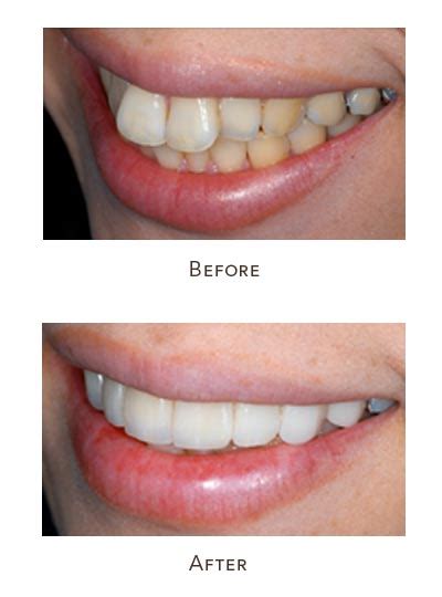 Veneers Before And After Buck Teeth