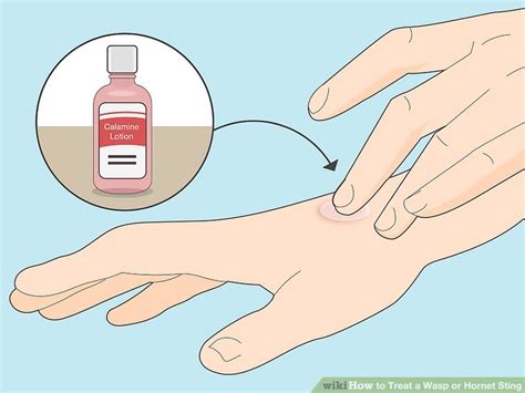 3 Ways to Treat a Wasp or Hornet Sting - wikiHow