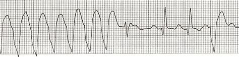 Fusion Beats - Dressler beat • LITFL • ECG Library Diagnosis