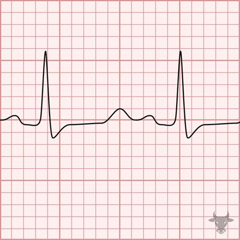 Hypocalcemia | ECG Stampede