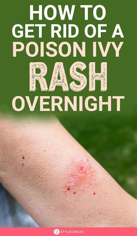 Poison Ivy Rash Rubbing Alcohol at Lan Lewis blog