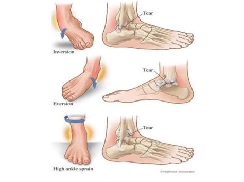 Ankle Sprain Grades