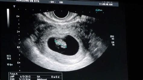 What Does A Baby Look Like At 8 Weeks Ultrasound - Baby Viewer