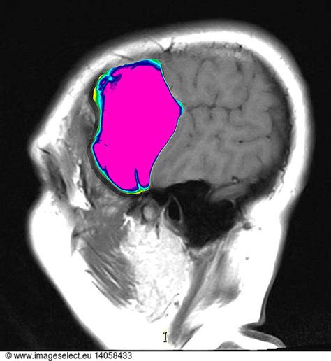 Enhanced Hemorrhagic Arachnoid Cyst Enhanced Hemorrhagic Arachnoid Cyst ...