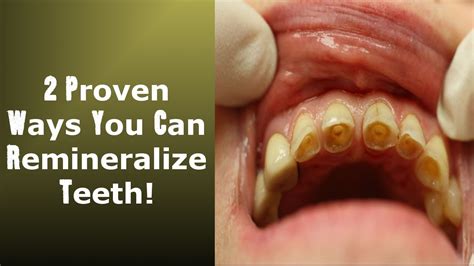 2 Little Known Ways To Achieve Tooth Remineralization: Easy To Implement ! - YouTube