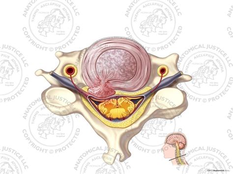 Left Cervical Degenerative Disc Herniation - No Text