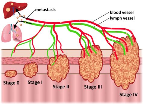 Colorectal Cancer Progression