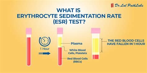 Understanding ESR Test and Erythrocyte Sedimentation Rate | Dr. Lal PathLabs