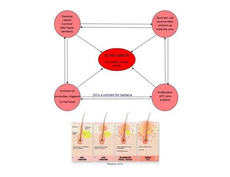 What Is Acne? | Causes, Symptoms & Treatments | Natural Acne Clinic