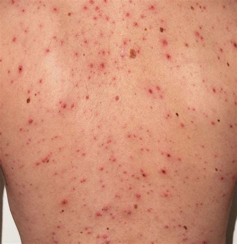 Chicken Pox Rash Adults