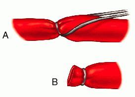 Ligature | definition of ligature by Medical dictionary