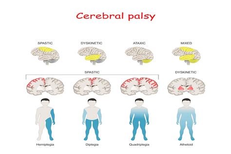 Types Of Cerebral Palsy